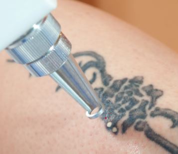 spokane tattoo removal cost